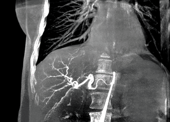 Image: The syngo DynaCT 360 software from Siemens speeds up rotational angiography (Photo courtesy of Siemens Healthcare).